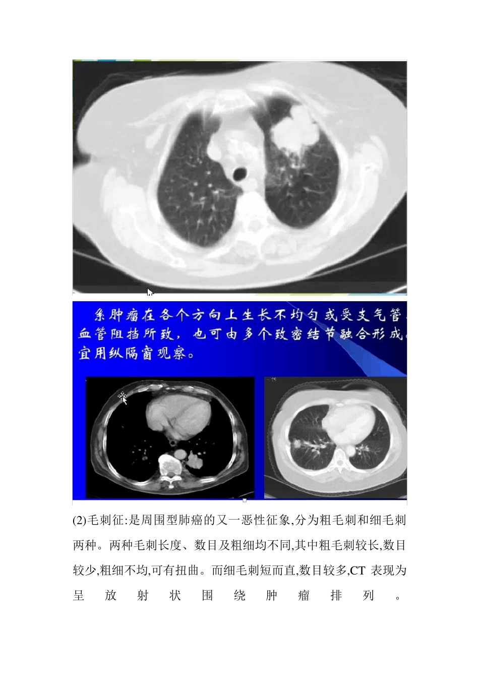 周围型肺癌的CT诊断与鉴别诊断_第2页