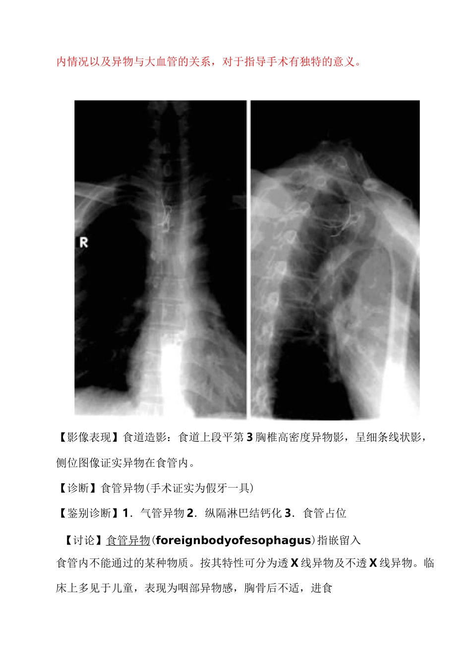 食管异物和气管异物鉴别诊断_第2页