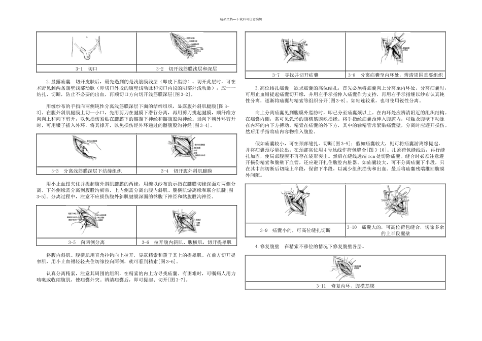 一般腹股沟斜疝修复术手术图谱_第2页