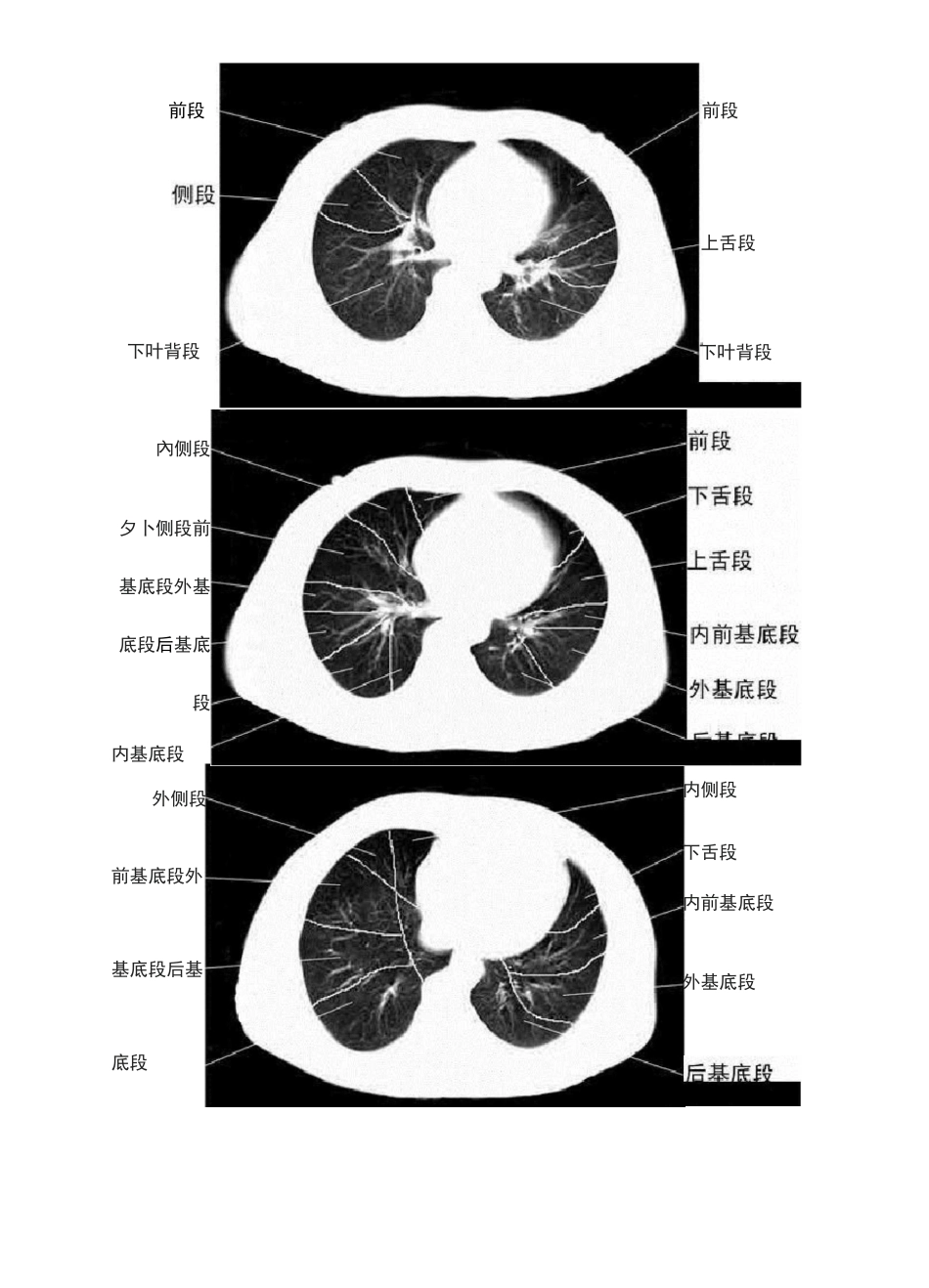 胸部CT肺段划分口诀_第3页