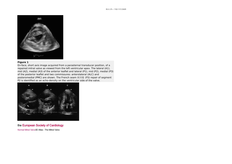 二尖瓣叶解剖图_第1页