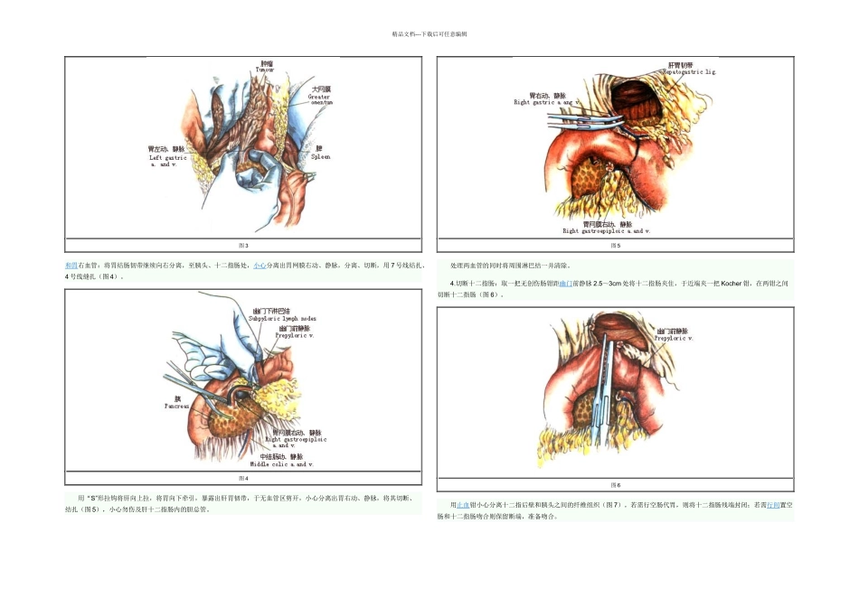 全胃切除示意图_第2页