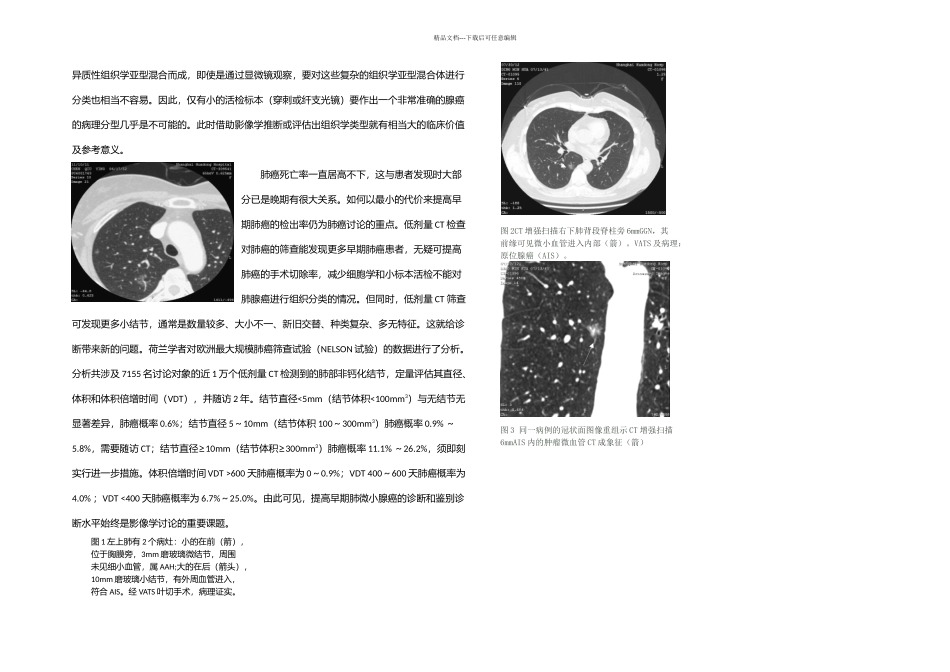 提高期肺腺癌检出率CT诊断是关键_第2页