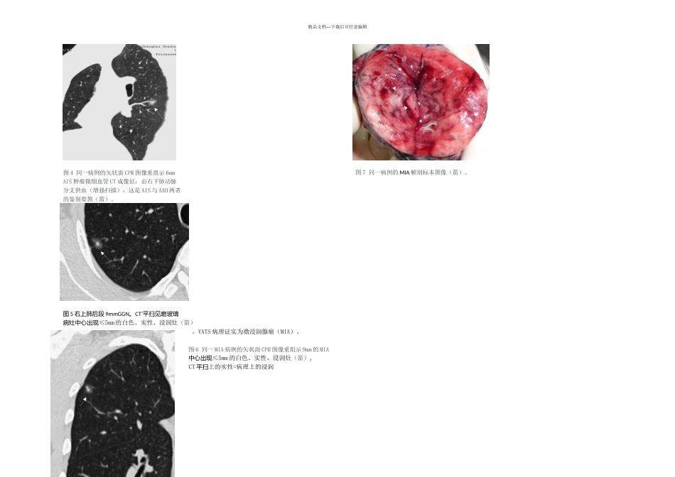 提高期肺腺癌检出率CT诊断是关键_第3页