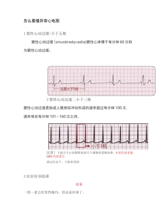 怎么看懂异常心电图