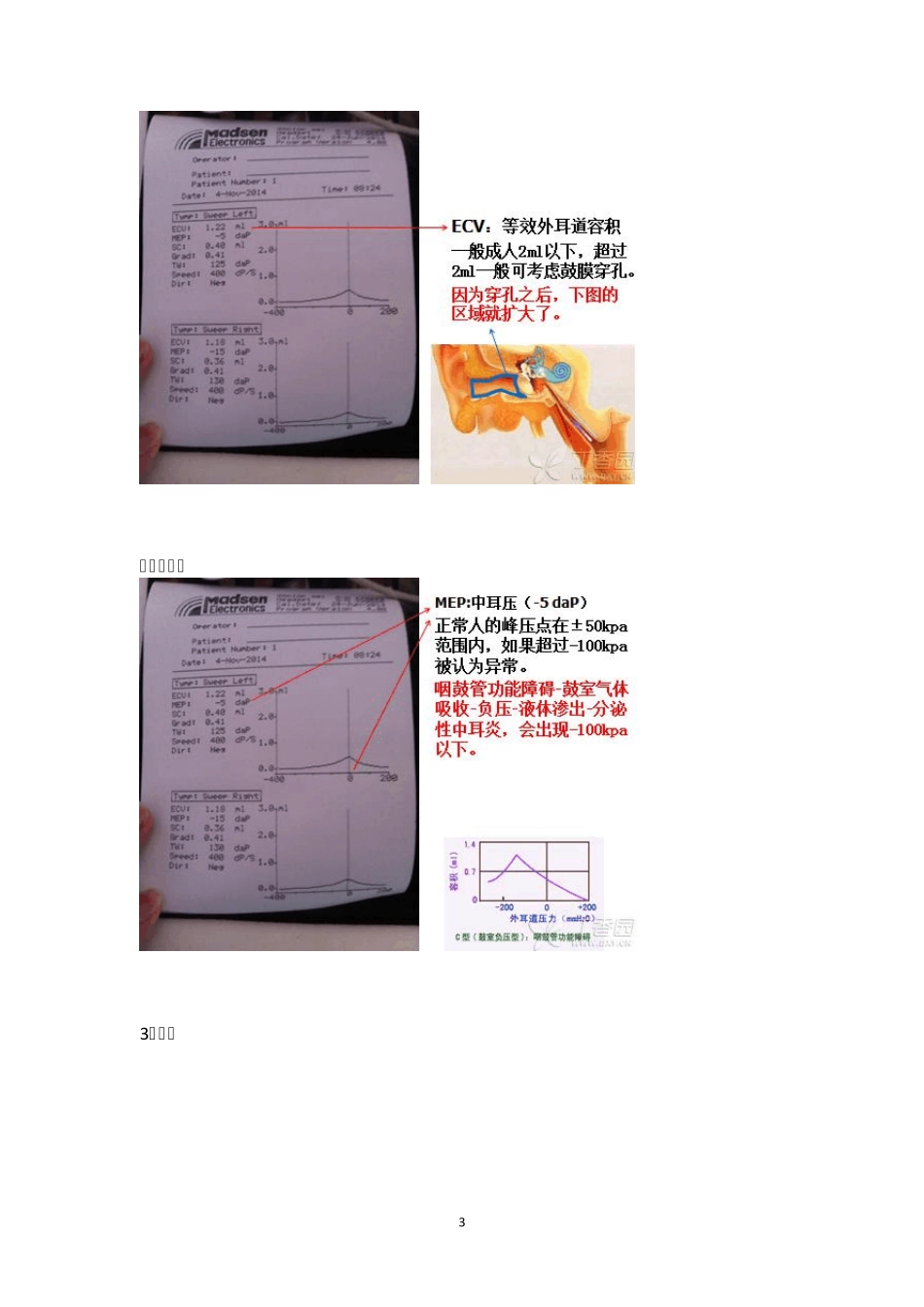 对声导抗的初步认识_第3页