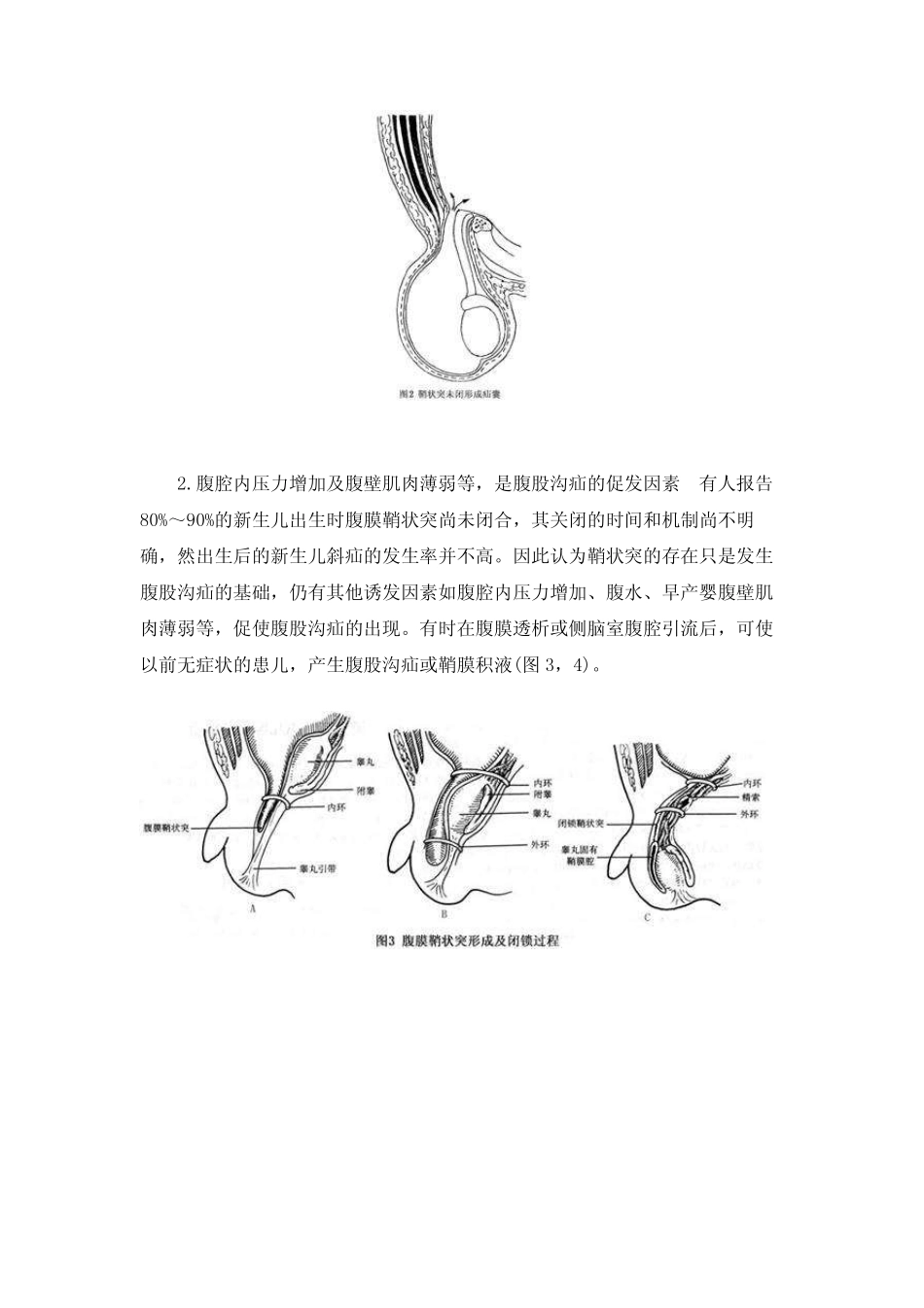 小儿腹股沟斜疝_第3页