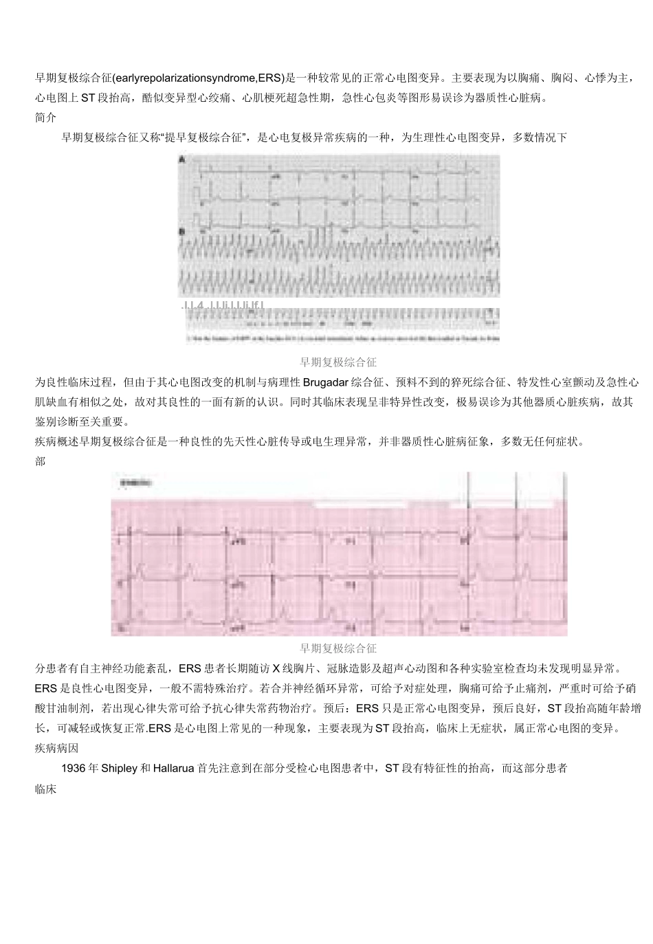早期复极综合症_第1页