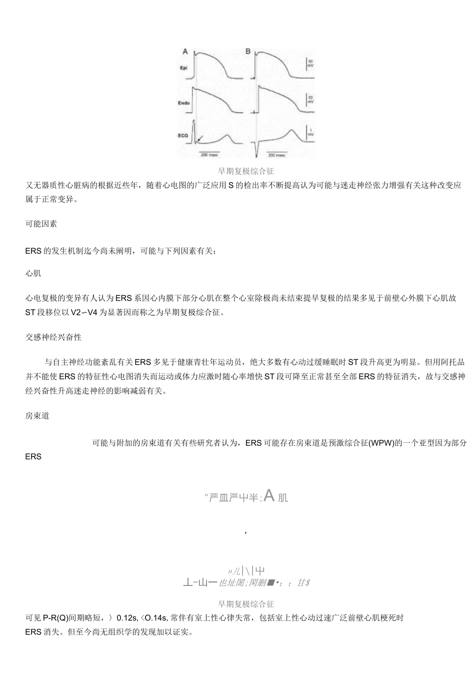 早期复极综合症_第2页