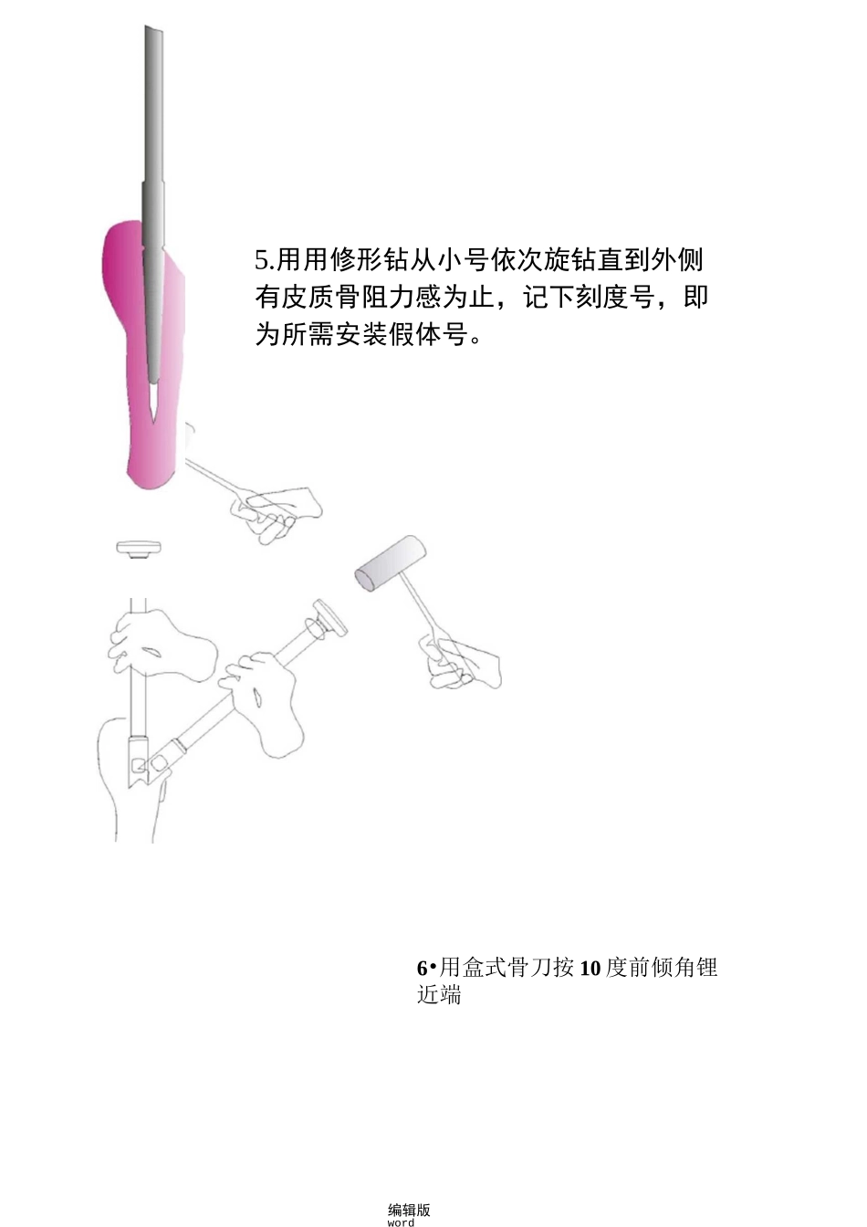 髋关节置换手术操作流程_第3页