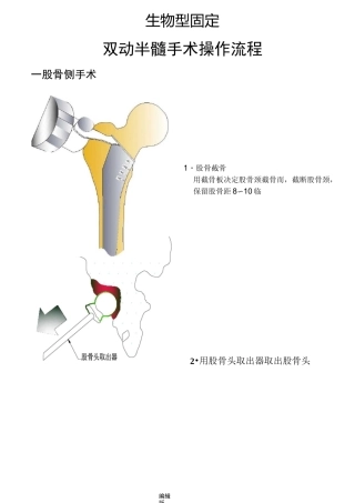 髋关节置换手术操作流程
