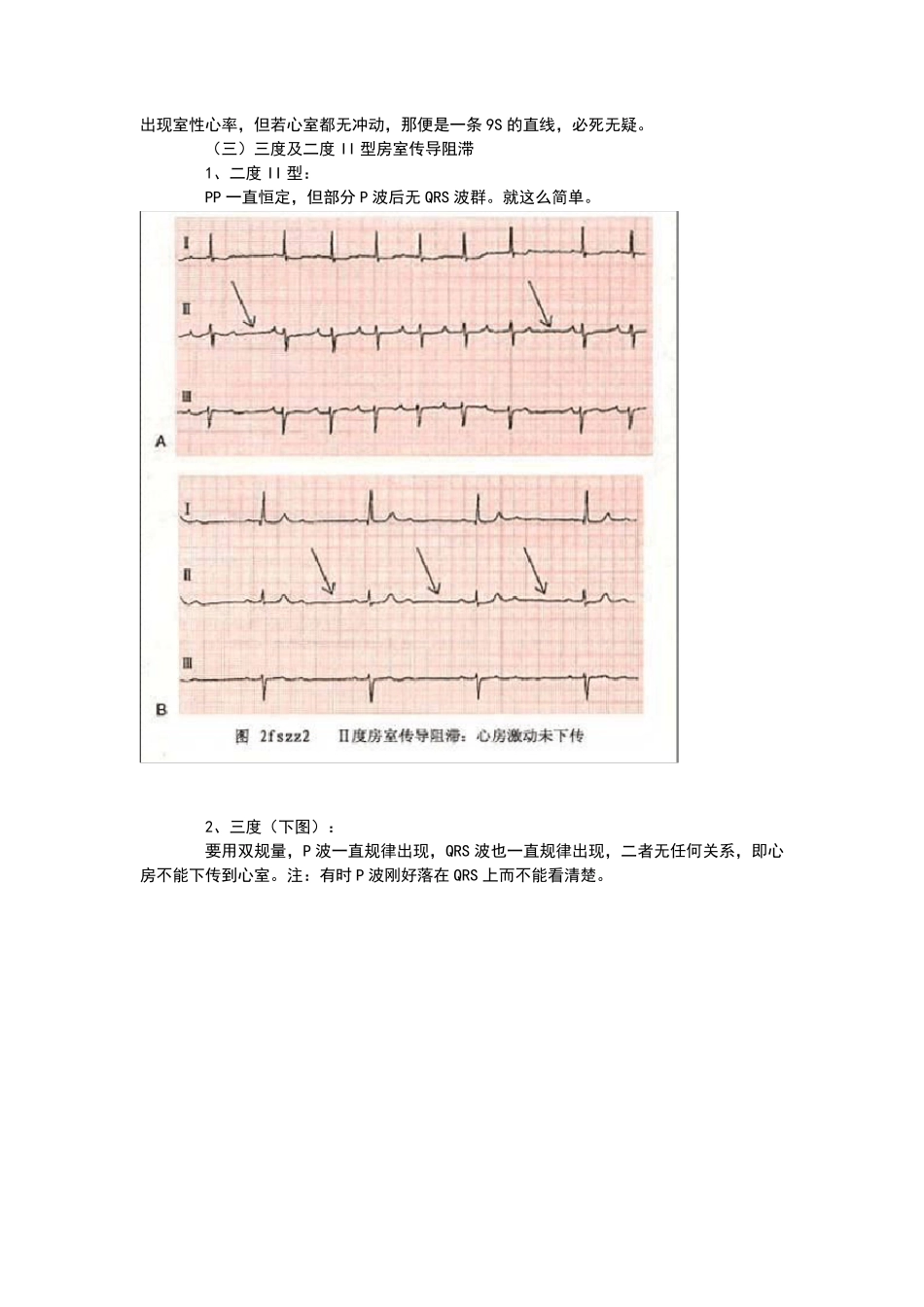 心电图基本讲解_第2页