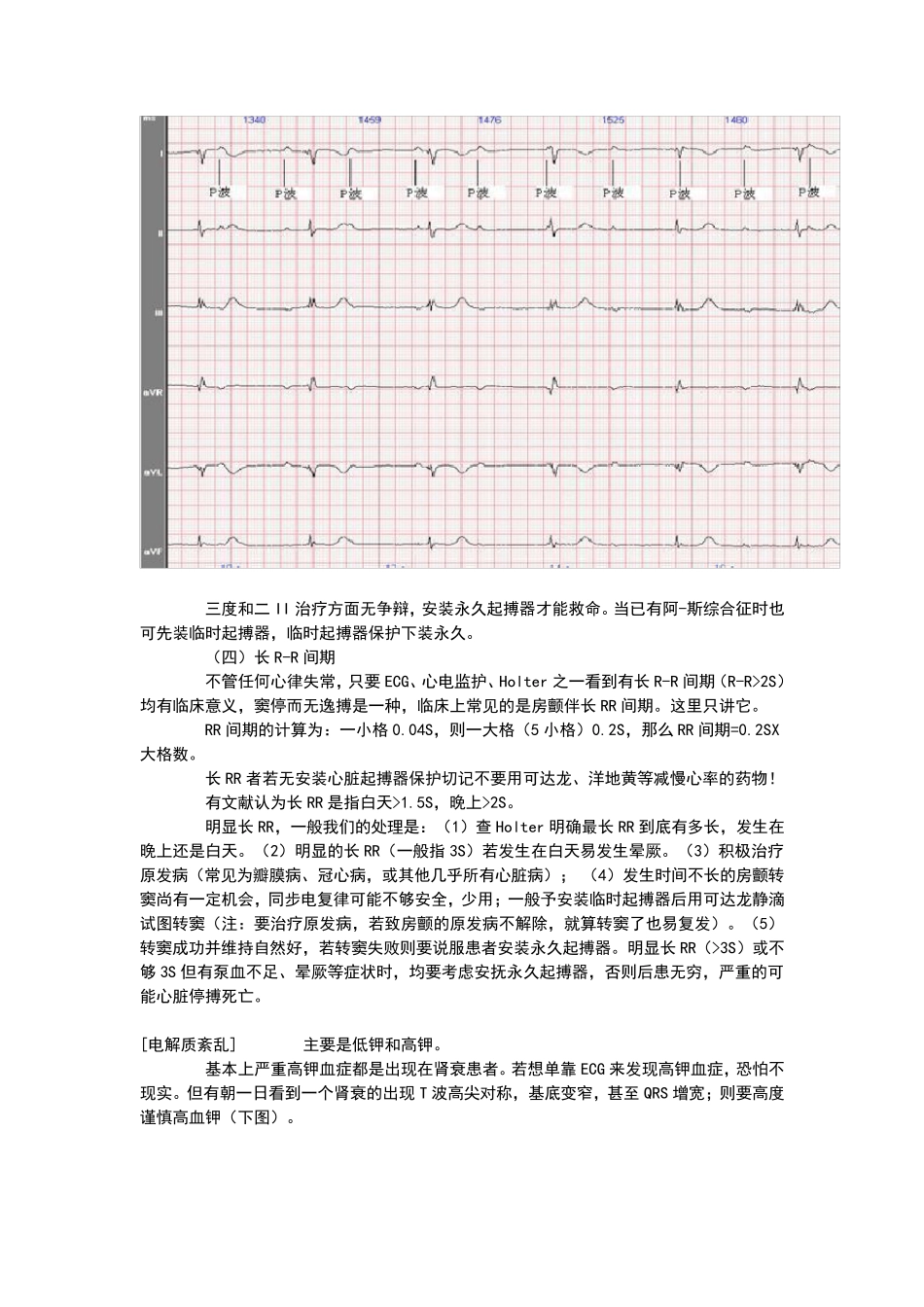 心电图基本讲解_第3页