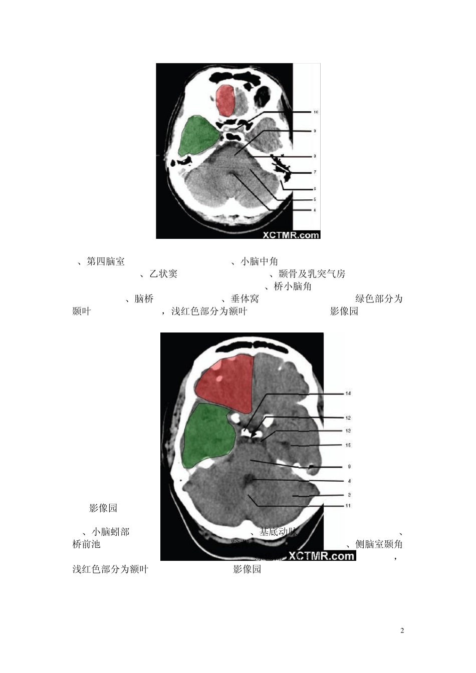怎么看头部CT_第2页