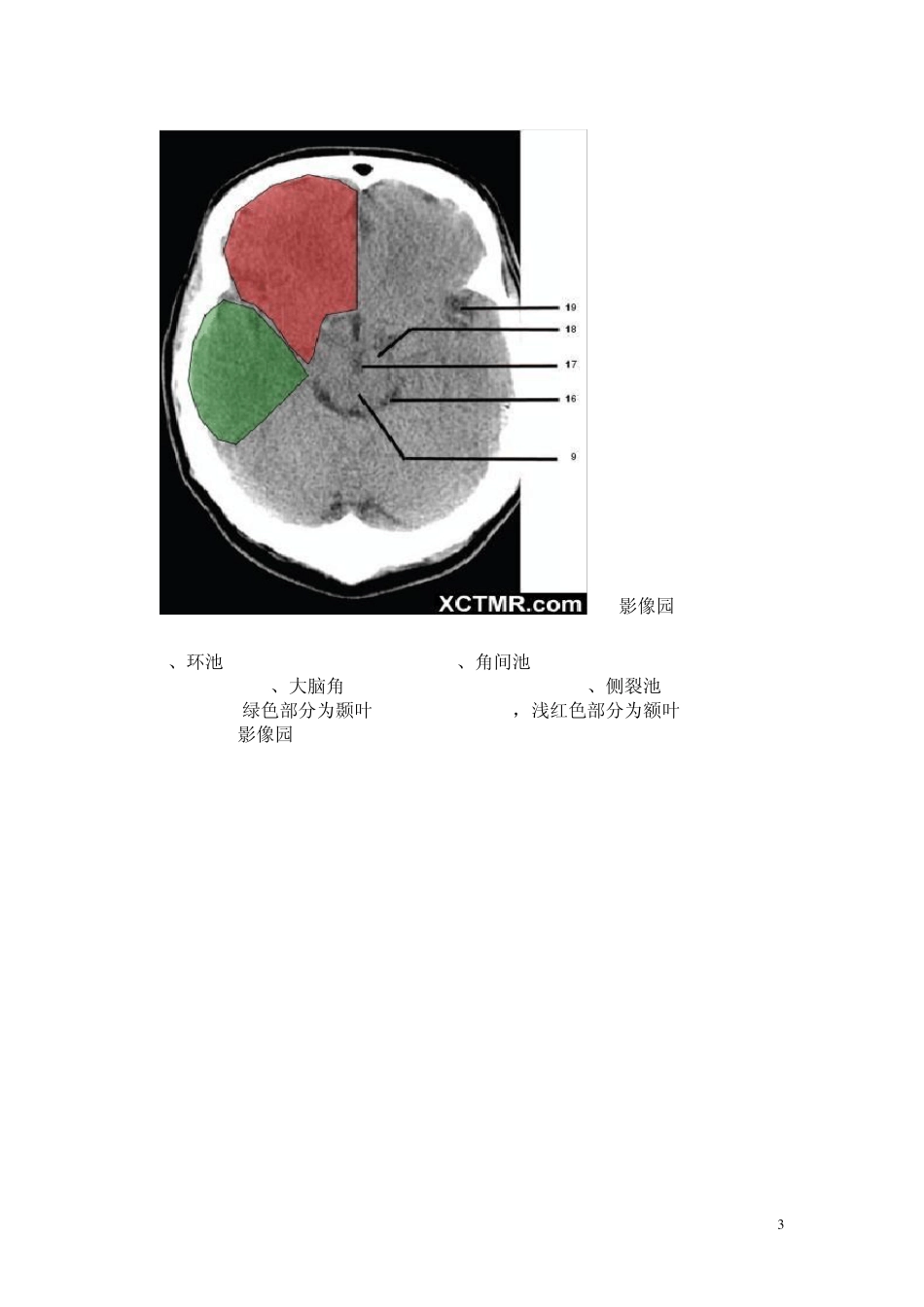怎么看头部CT_第3页