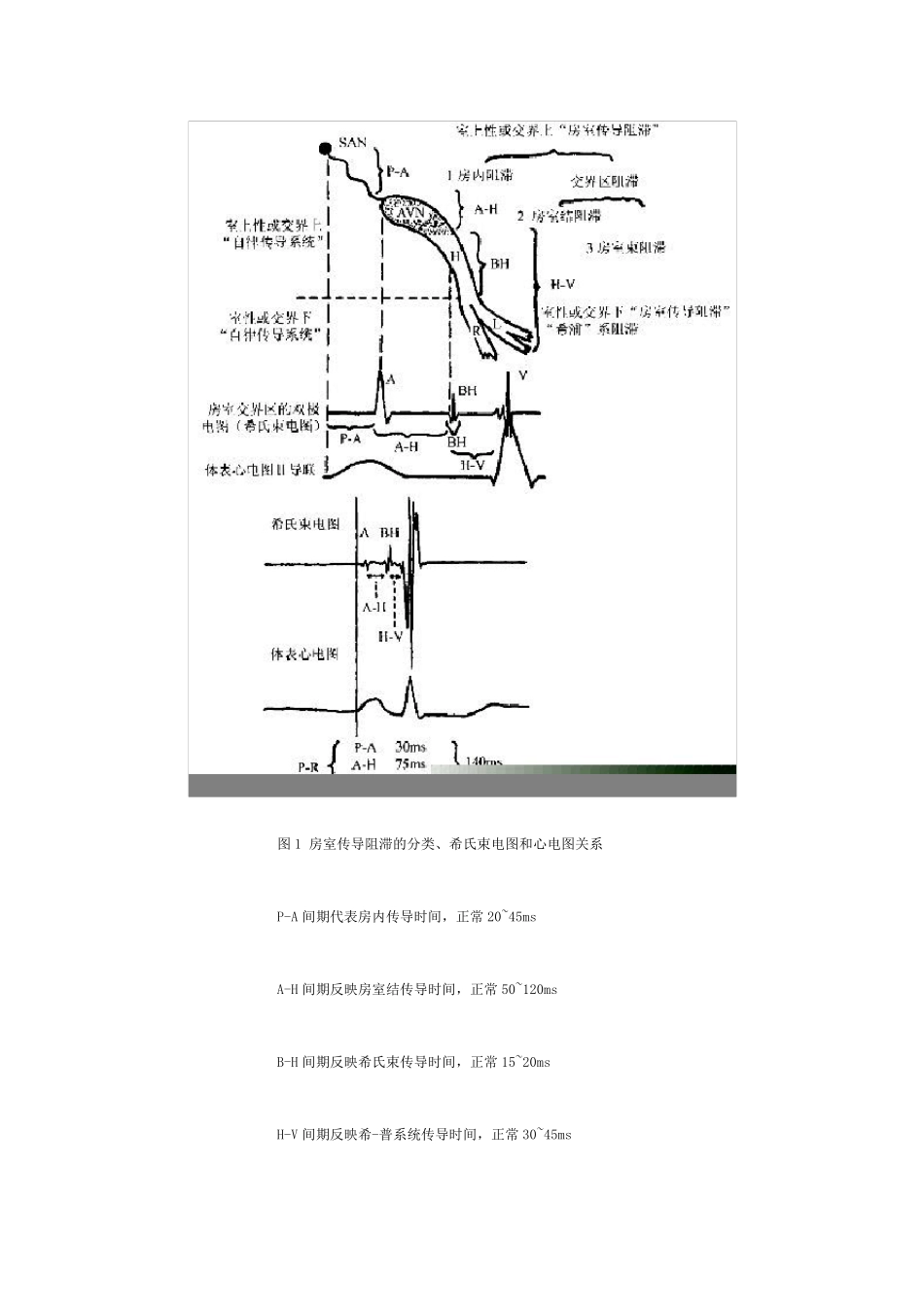 房室传导阻滞的心电图与电生理_第2页