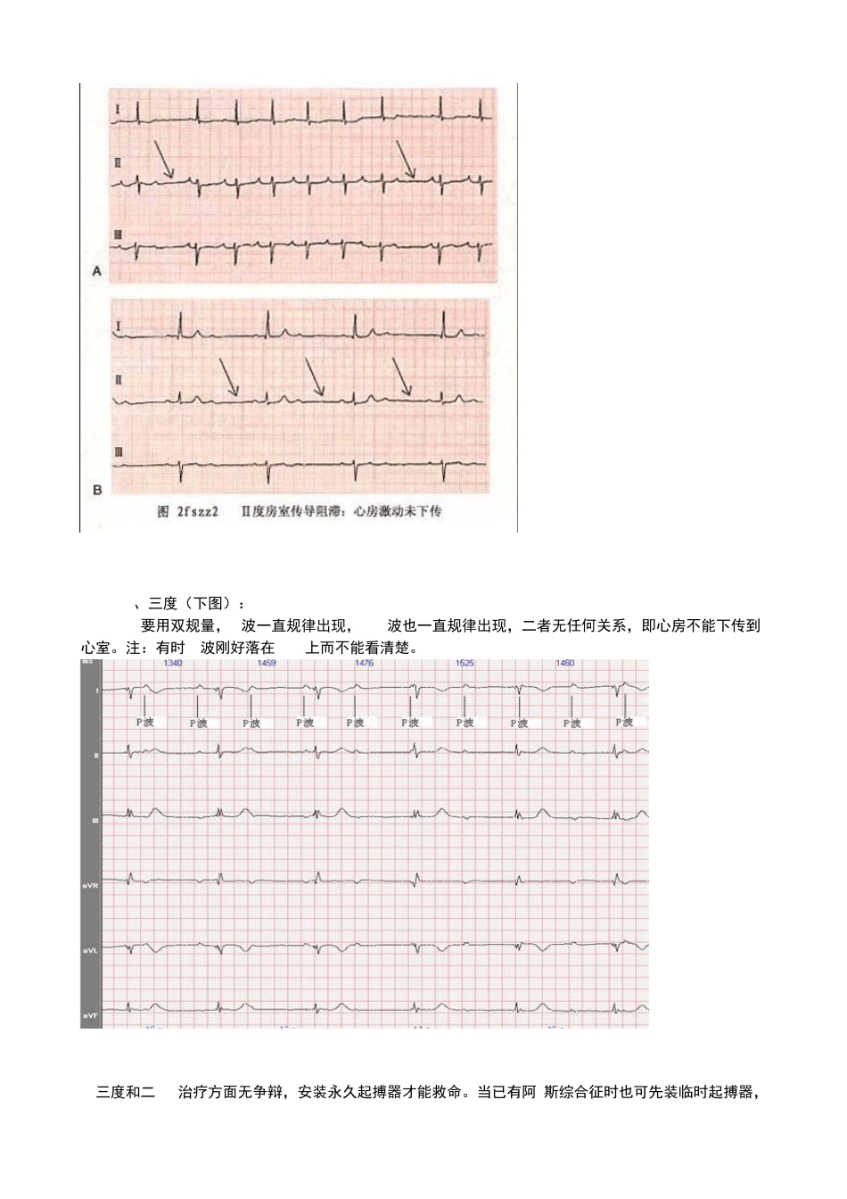 房室传导阻滞治疗_第2页