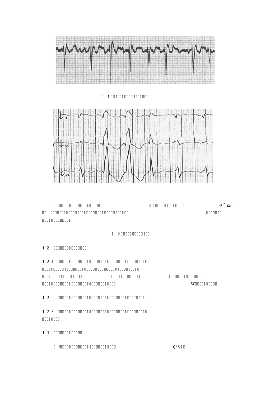 房颤时室早及室内差传的特点与鉴别_第2页