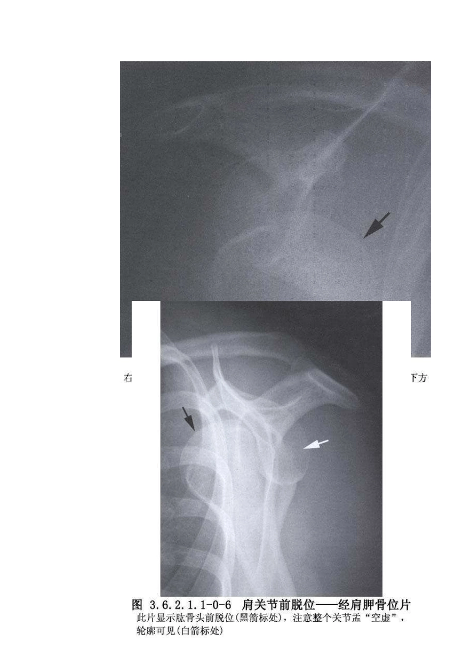 手术_3.6.2.1.1陈旧性肩关节前脱位切开复位术_第3页