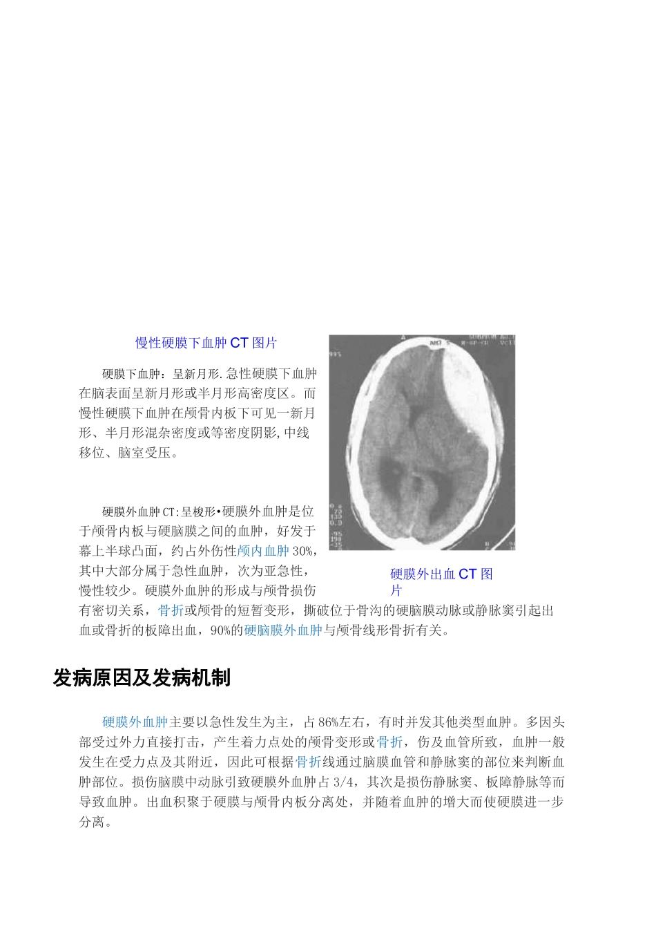 硬膜下与硬膜外血肿._第2页