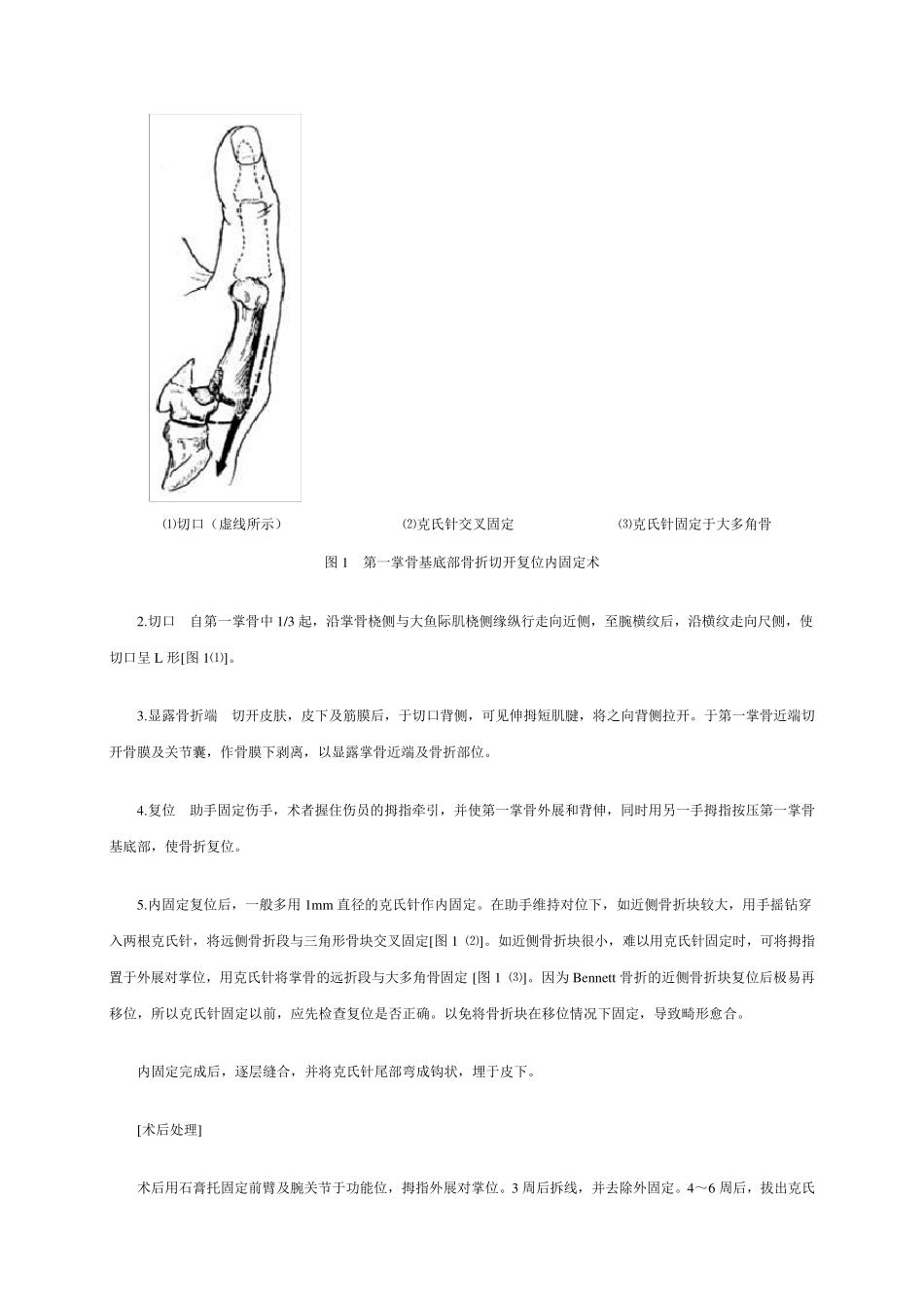 掌、指骨骨折切开复位内固定术_第2页