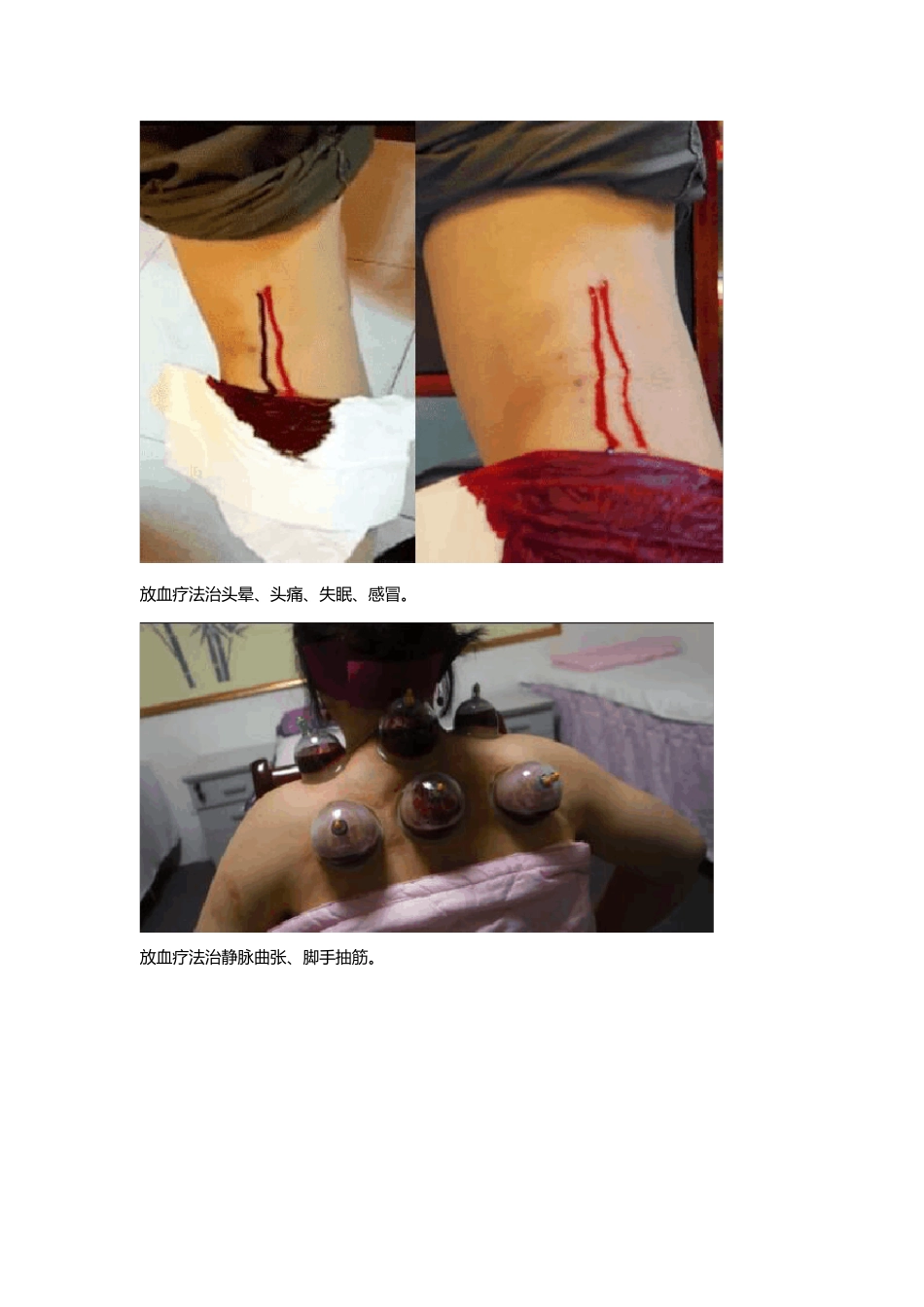 放血疗法治百病图解_第3页