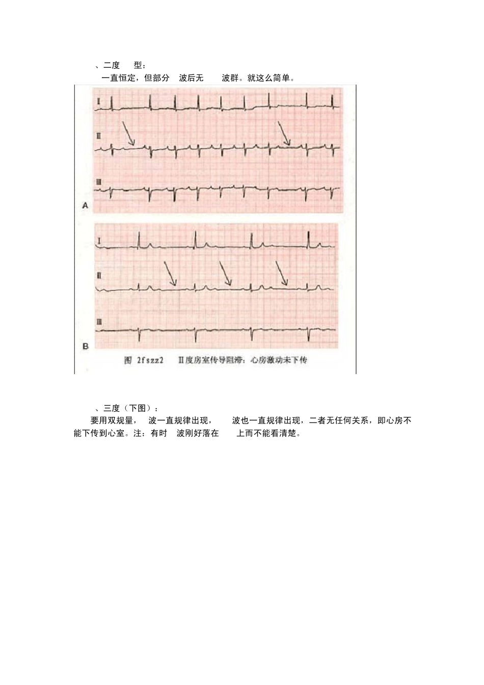 教你快速看懂心电图_第2页