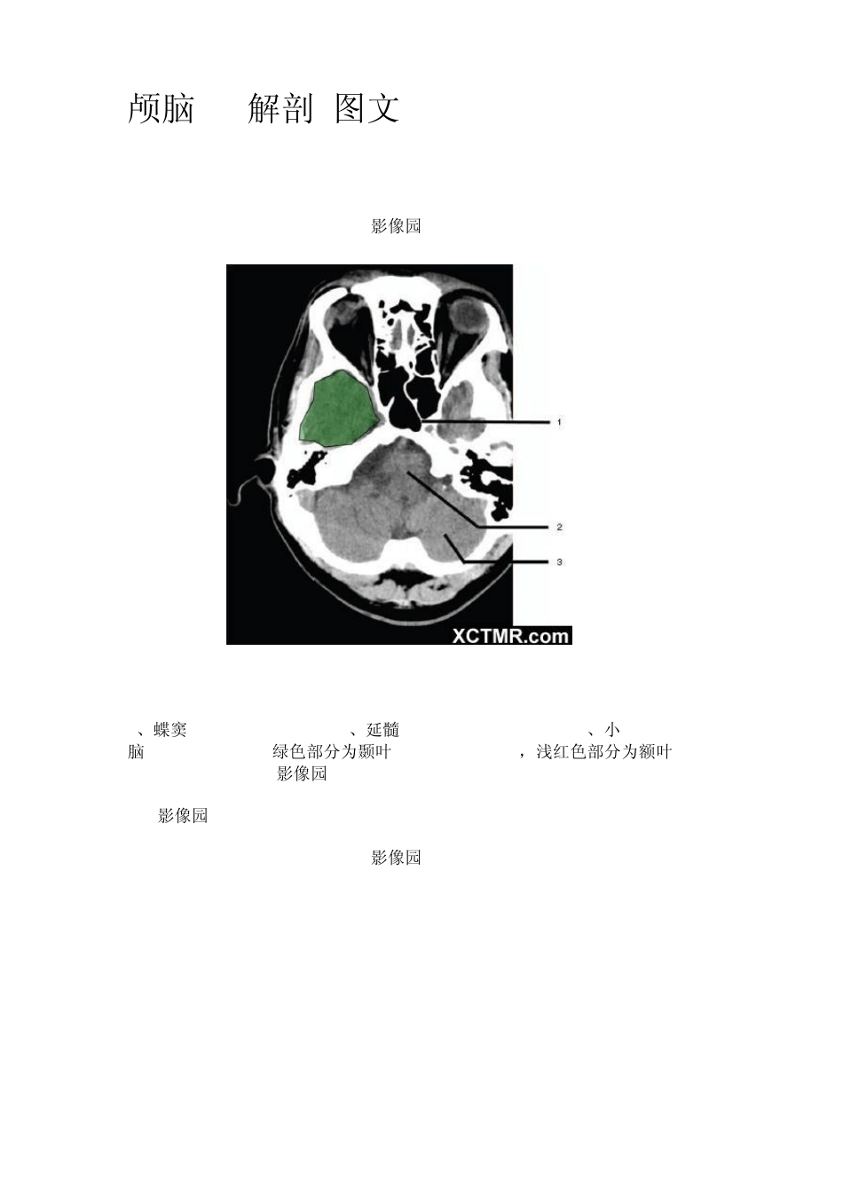 教你看头颅CT_第1页