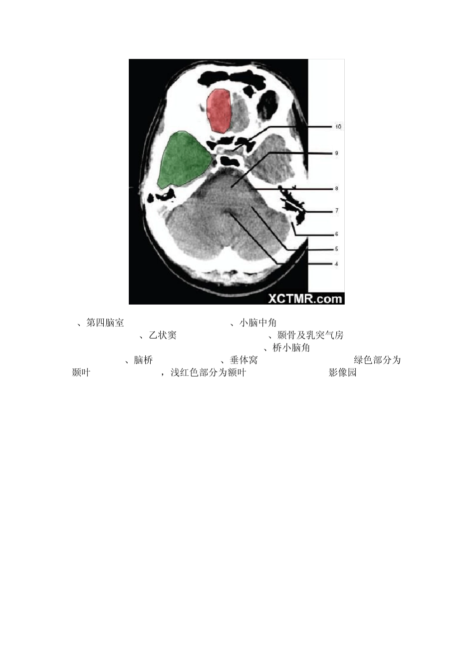 教你看头颅CT_第2页