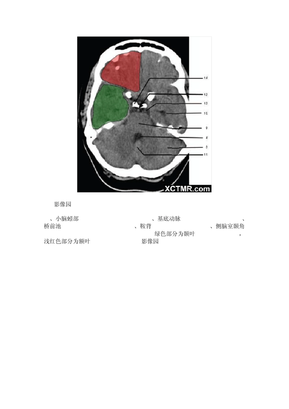 教你看头颅CT_第3页