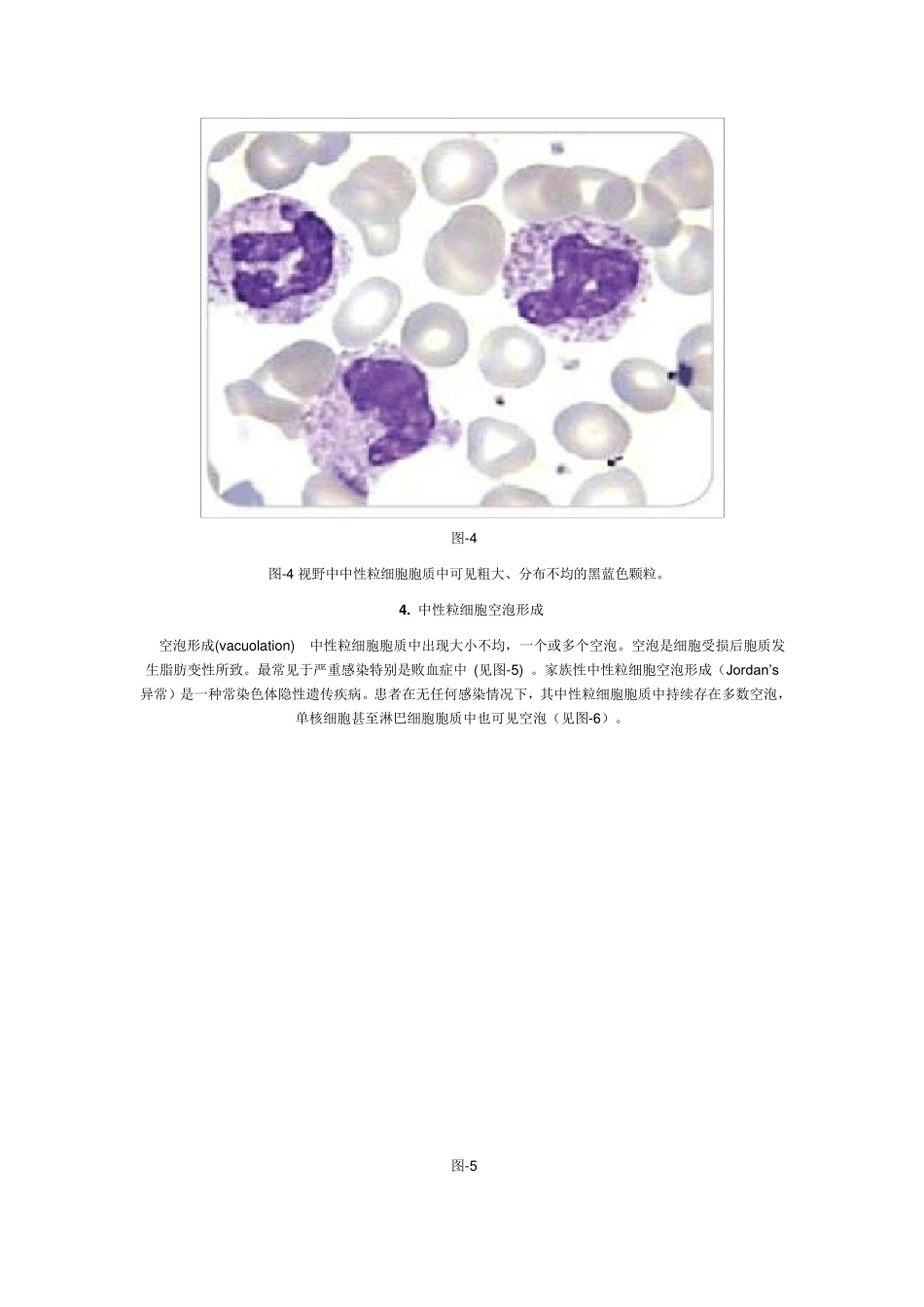 末梢血涂片白细胞形态变化及临床意义_第3页