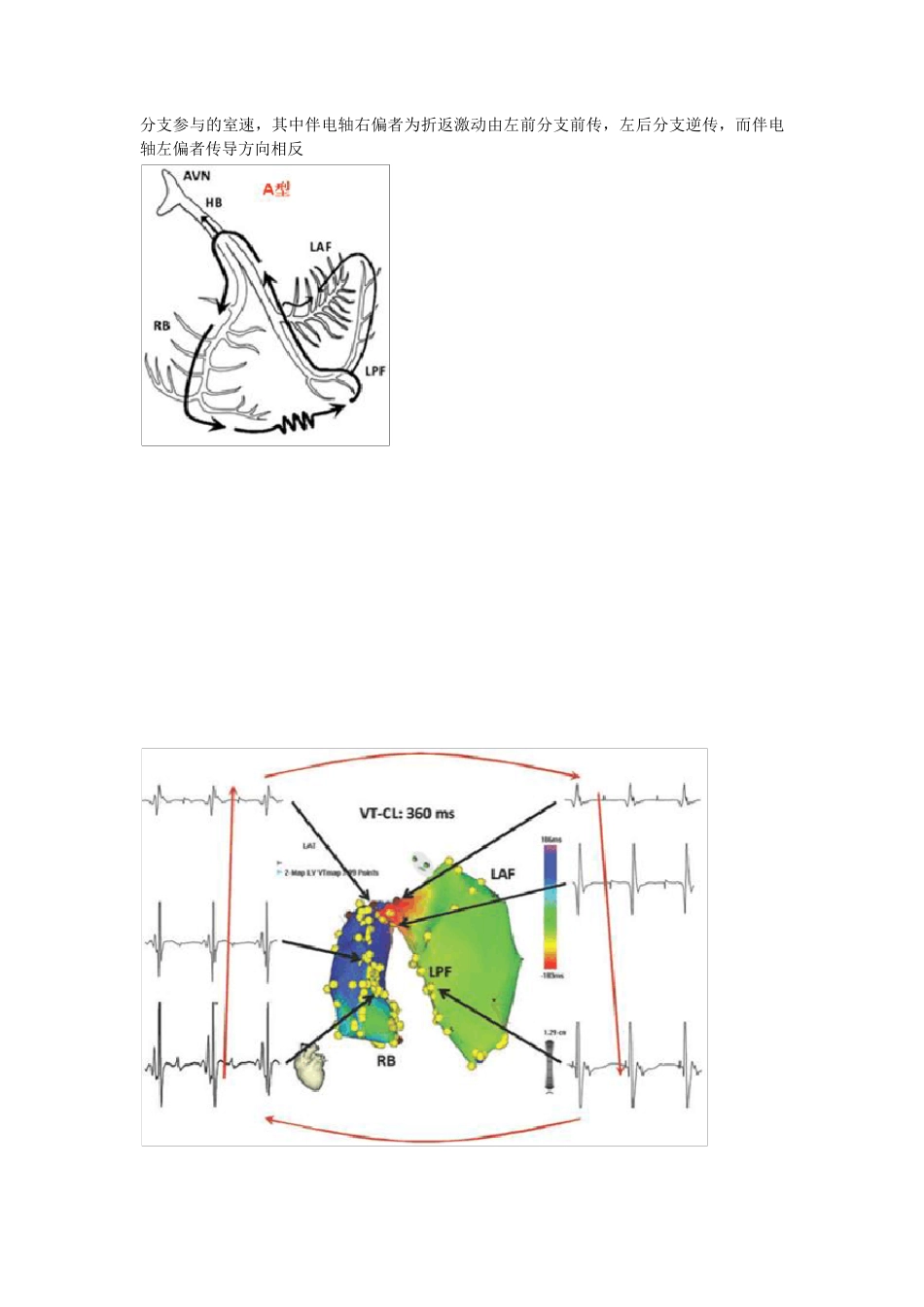 束支折返性室性心动过速_第2页