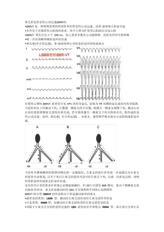 束支折返性室性心动过速