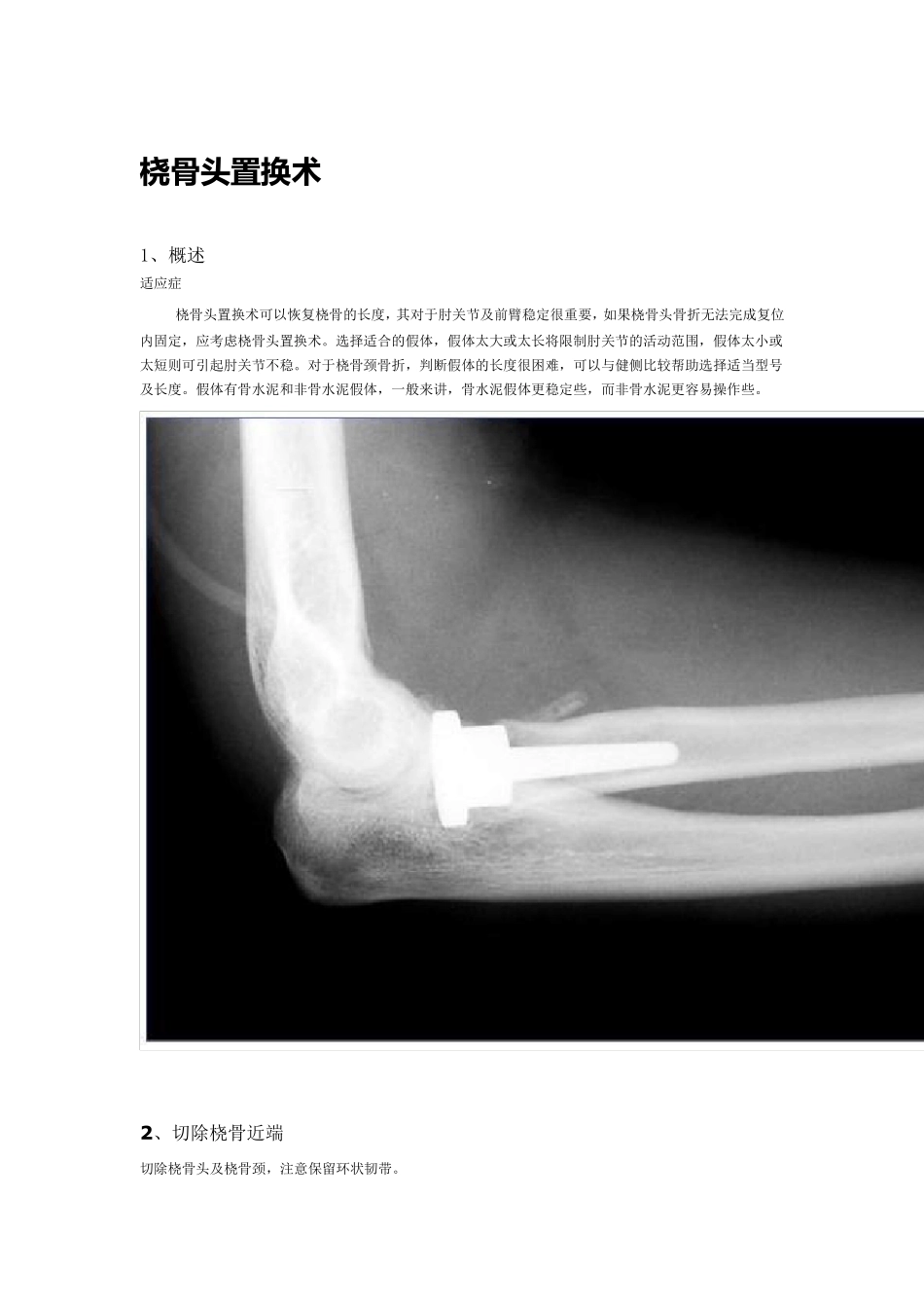 桡骨头置换术_第1页