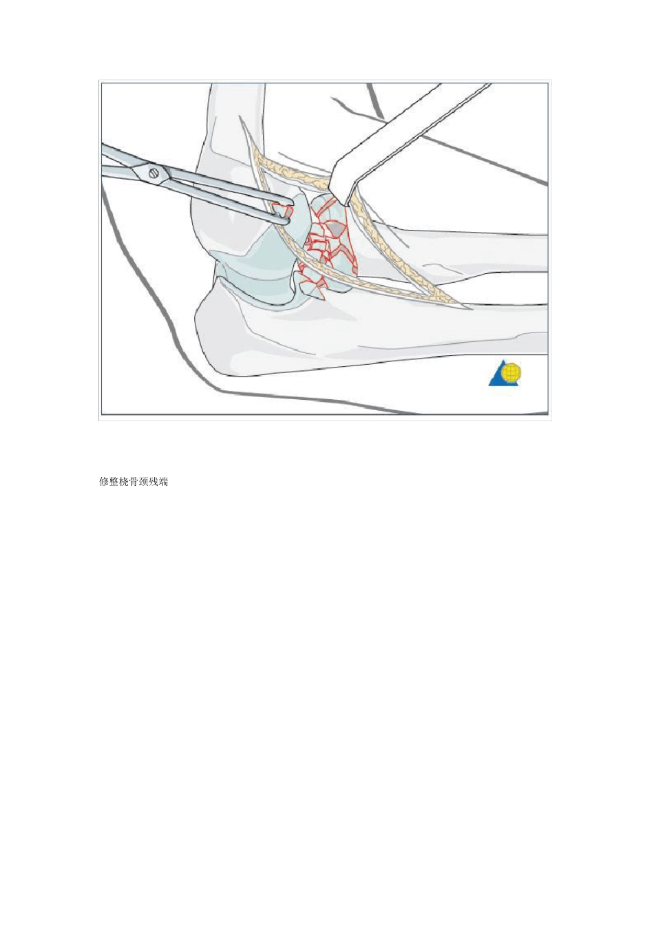 桡骨头置换术_第2页