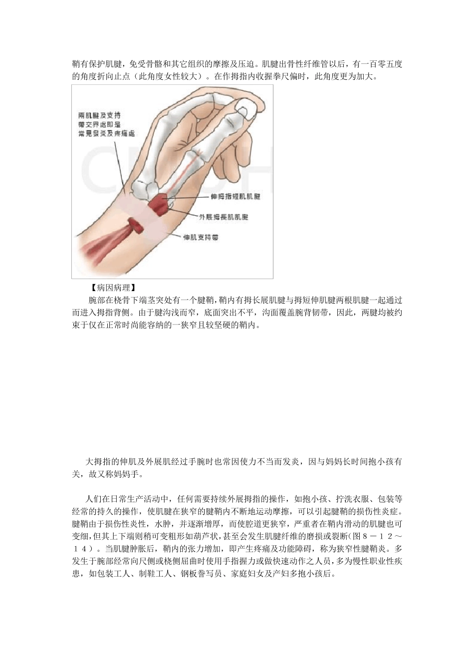 桡骨茎突部狭窄性腱鞘炎(妈妈手)_第2页