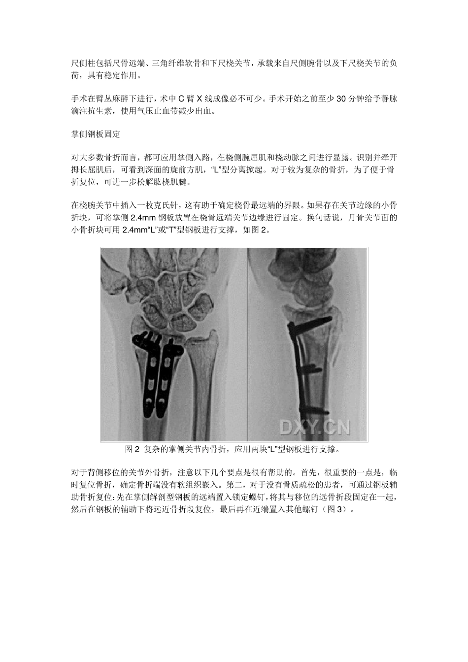 桡骨远端骨折锁定钢板内固定：手术技巧_第2页