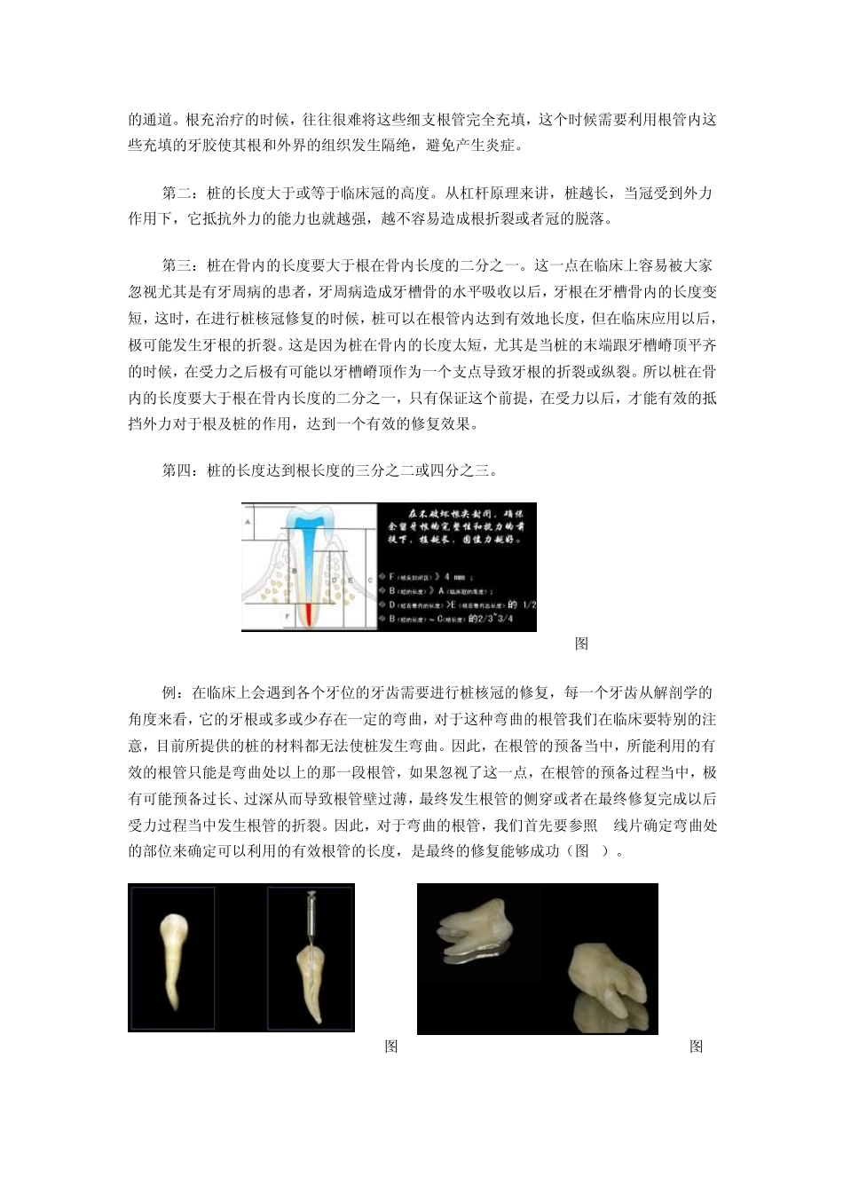 桩的牙体预备和印模_第2页