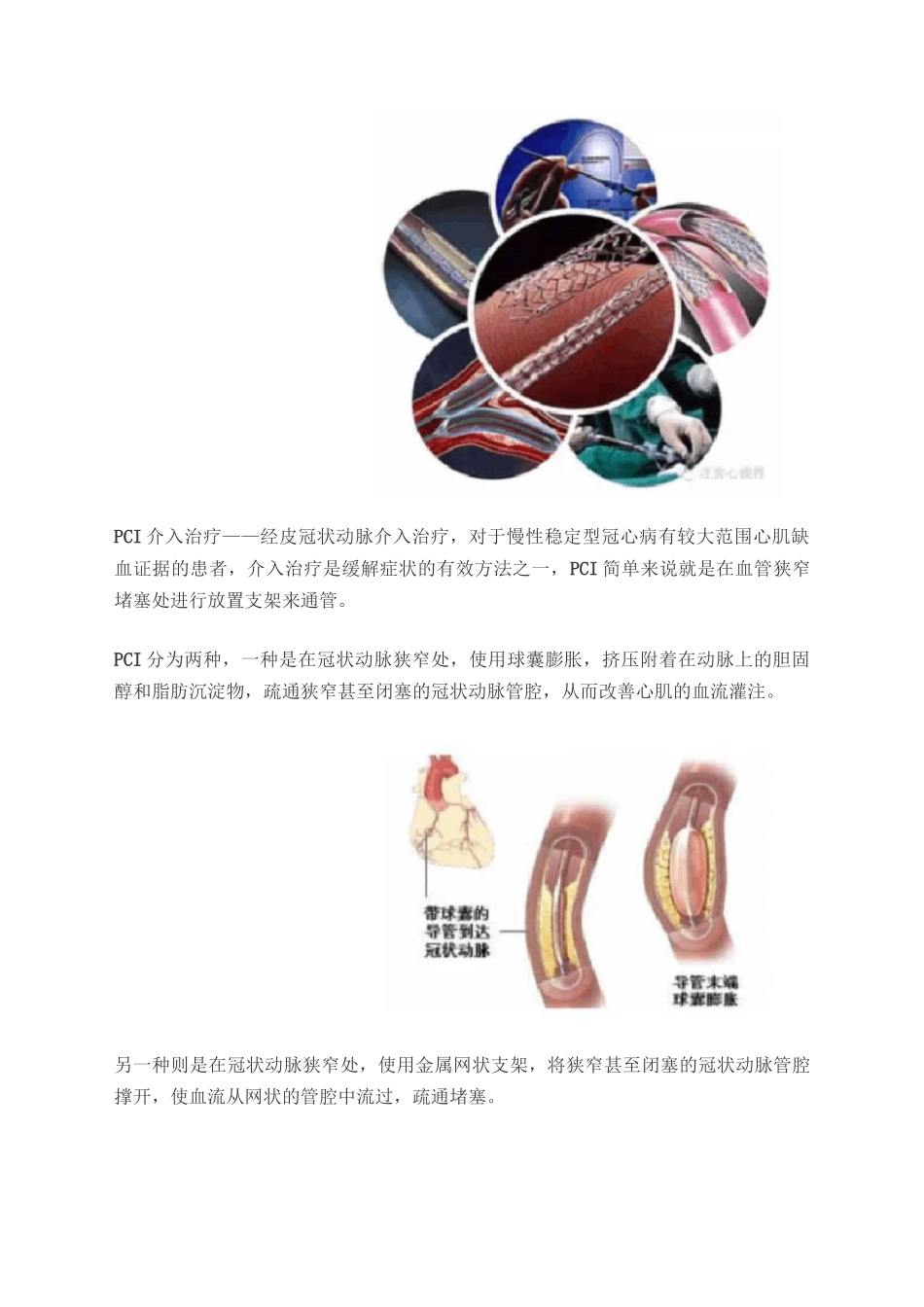 什么是冠心病_第3页