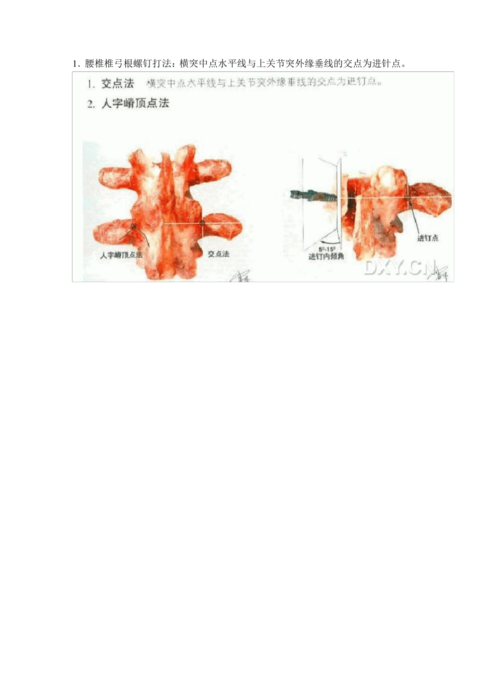 椎弓根螺钉进针图文并茂_第1页