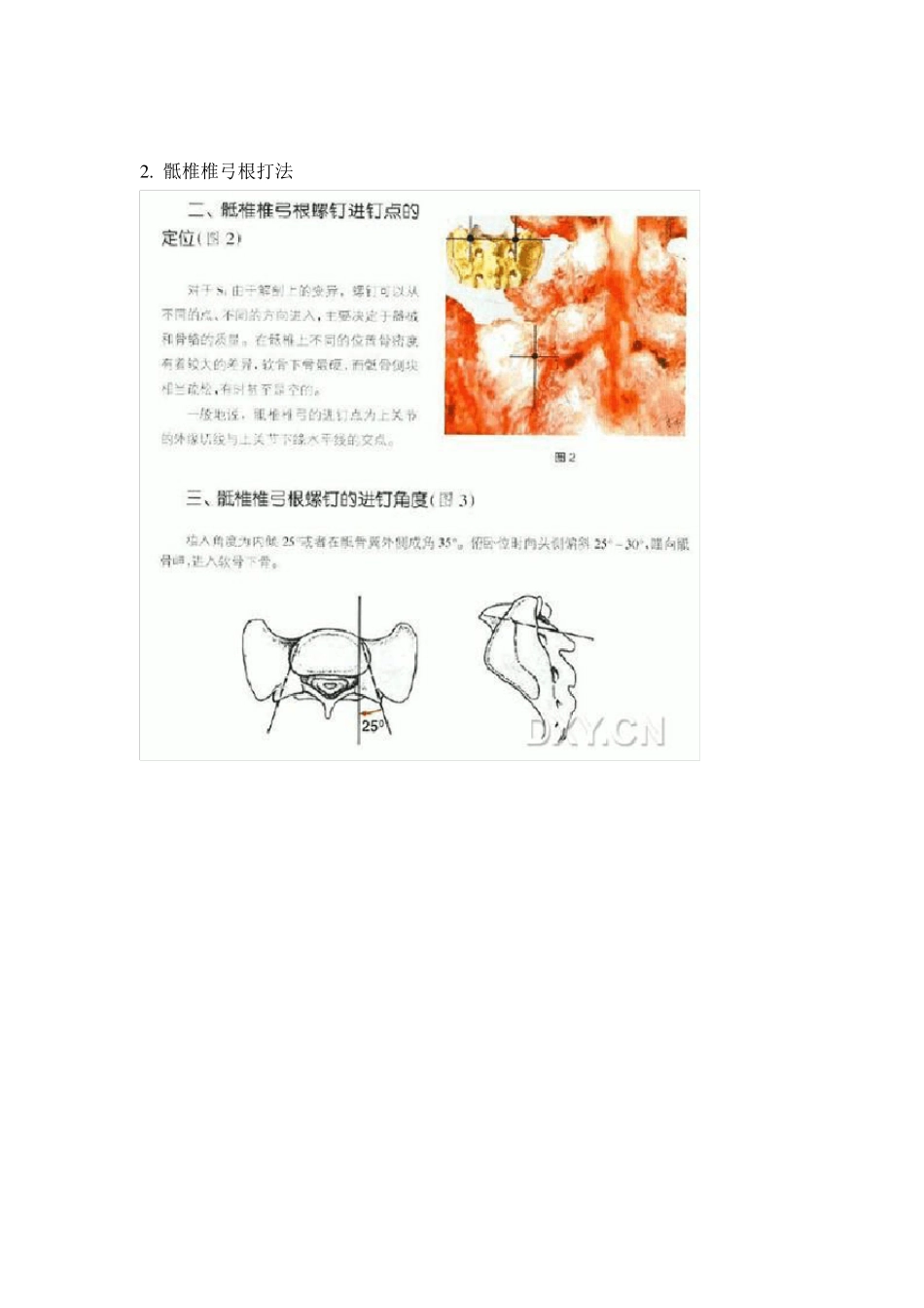 椎弓根螺钉进针图文并茂_第3页