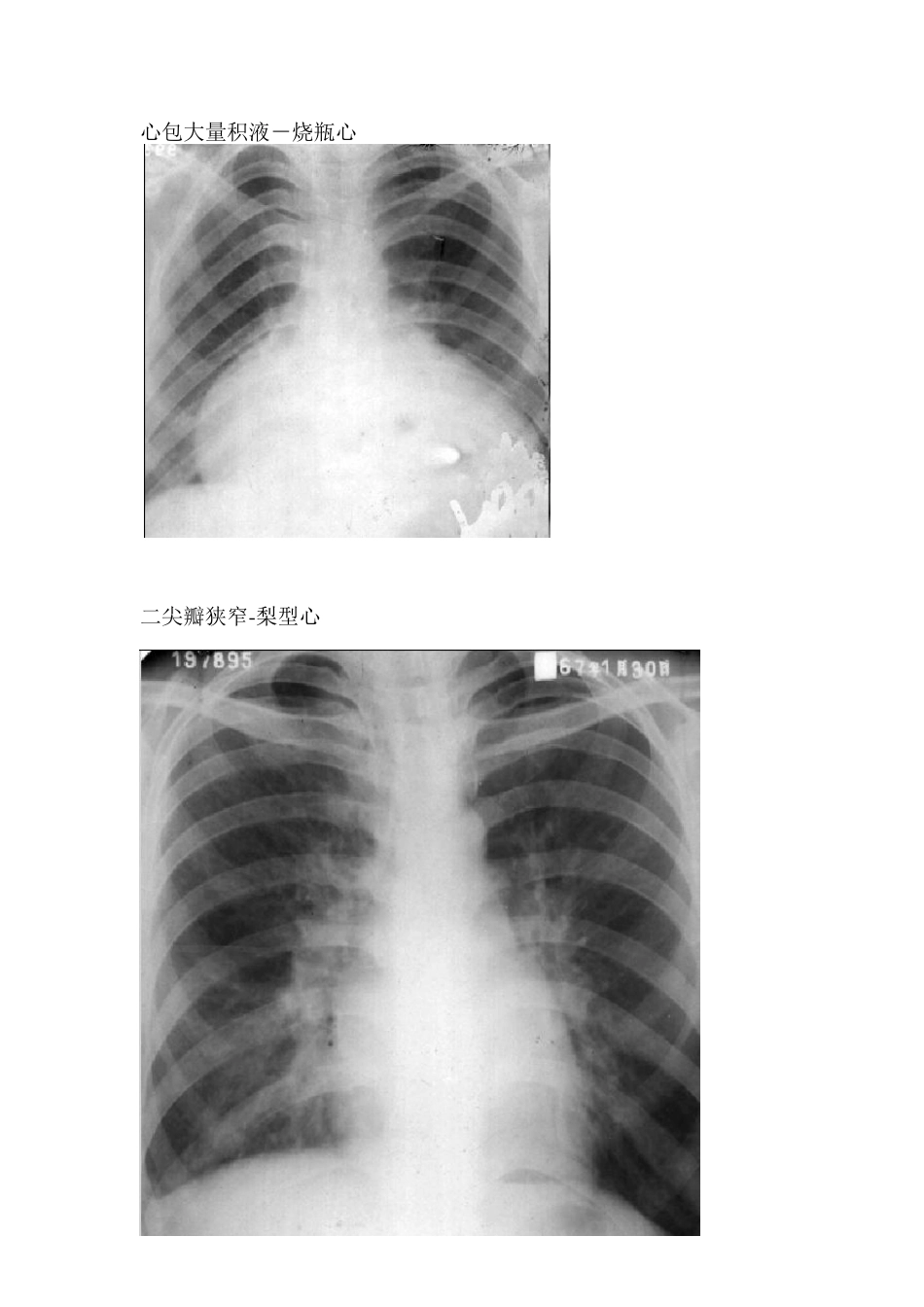 正常和异常X线胸片_第1页