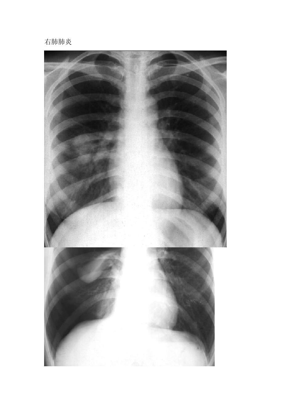 正常和异常X线胸片_第3页