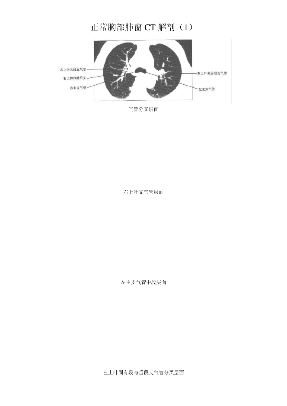 正常胸部CT解剖(肺窗和纵隔窗)_第1页