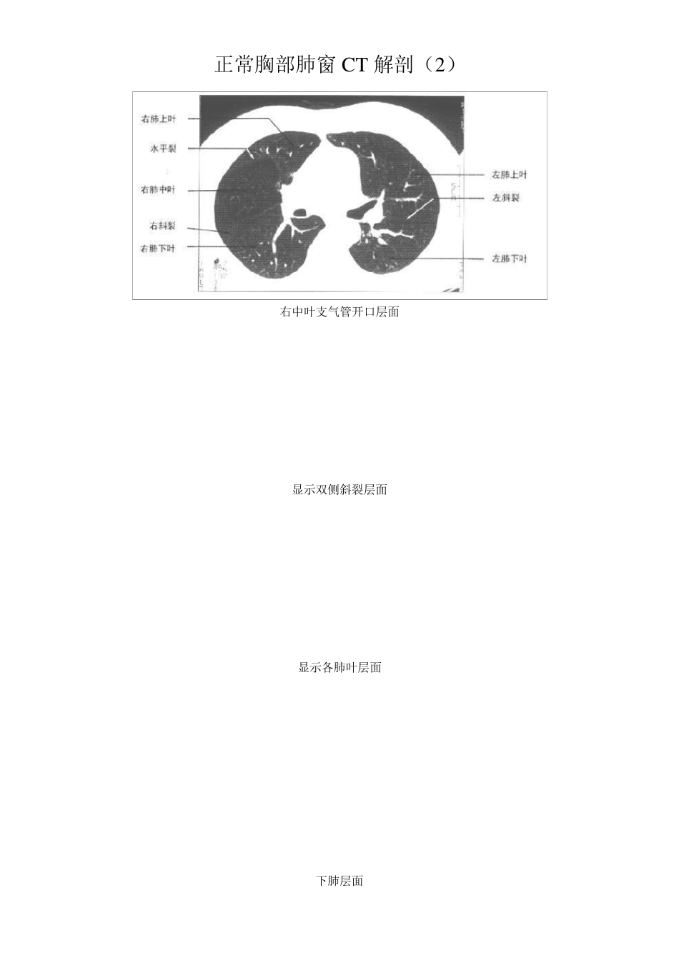 正常胸部CT解剖(肺窗和纵隔窗)_第2页