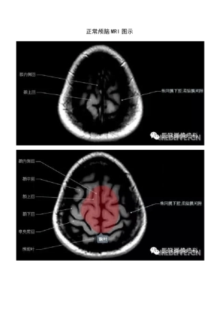 正常颅脑磁共振图示