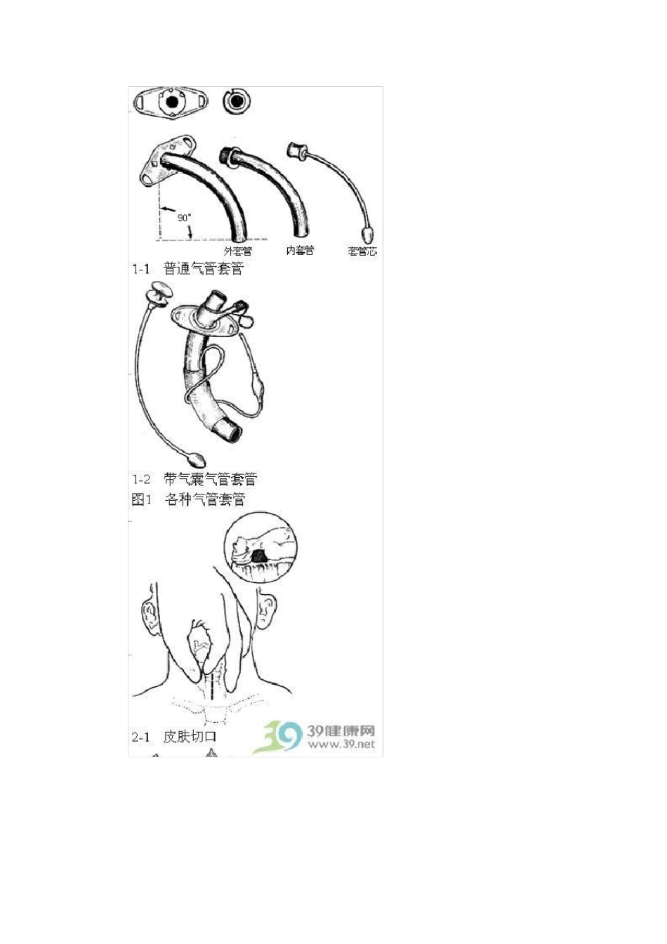 气管切开术手术步骤详解_第2页