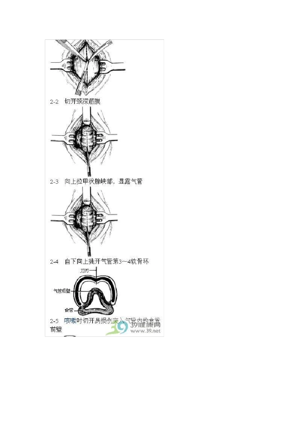 气管切开术手术步骤详解_第3页