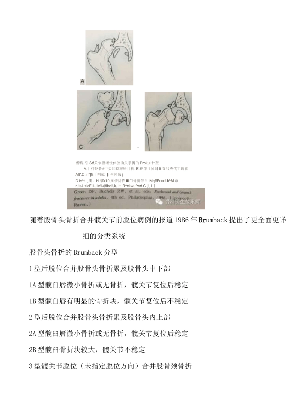 Pipkin 骨折_第2页