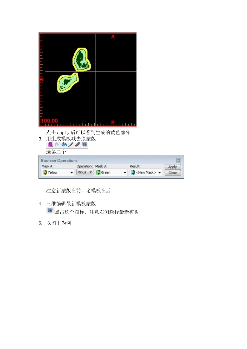 mimics手术导板制作-简单易行_第2页